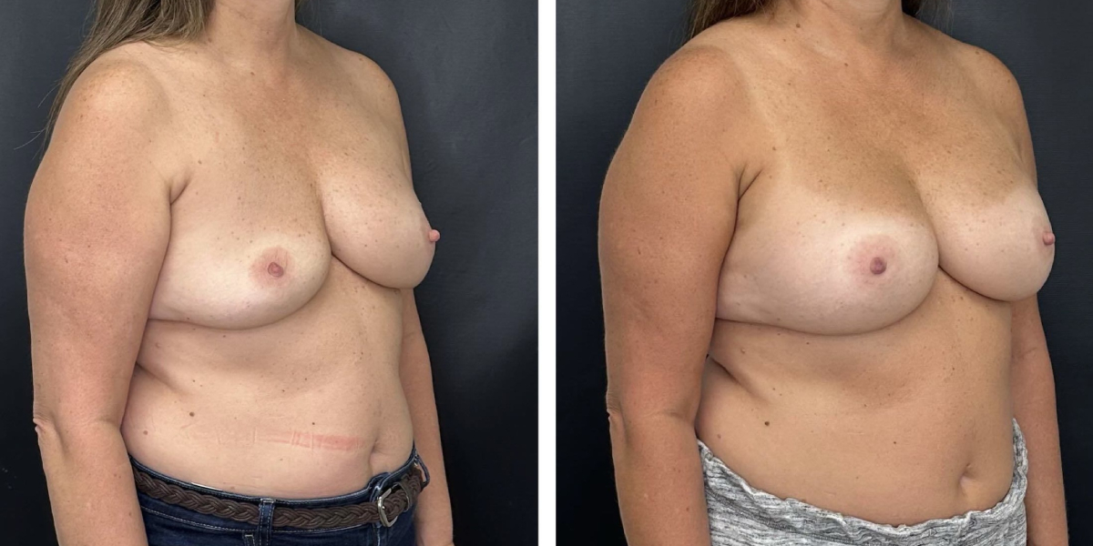 before and after breast implant exchange female patient right angle view case 4744