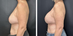 before and after breast implant exchange female patient left side view case 4750