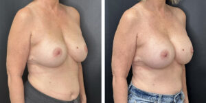 before and after breast implant exchange female patient right angle view case 4750
