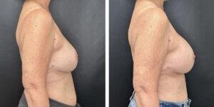 before and after breast implant exchange female patient right side view case 4750