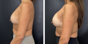 before and after breast implant exchange female patient left side view case 4756