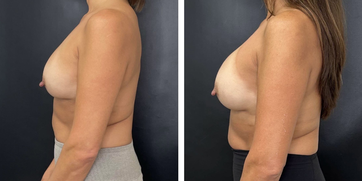 before and after breast implant exchange female patient left side view case 4756