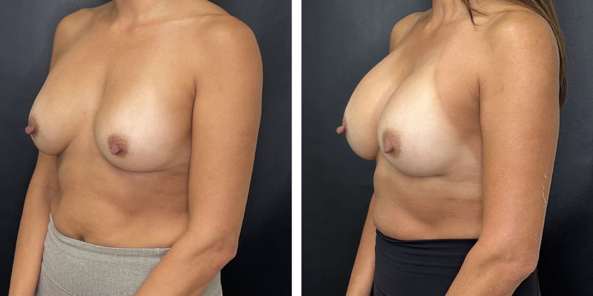 before and after breast implant exchange female patient left angle view case 4756
