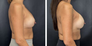 before and after breast implant exchange female patient right side view case 4756