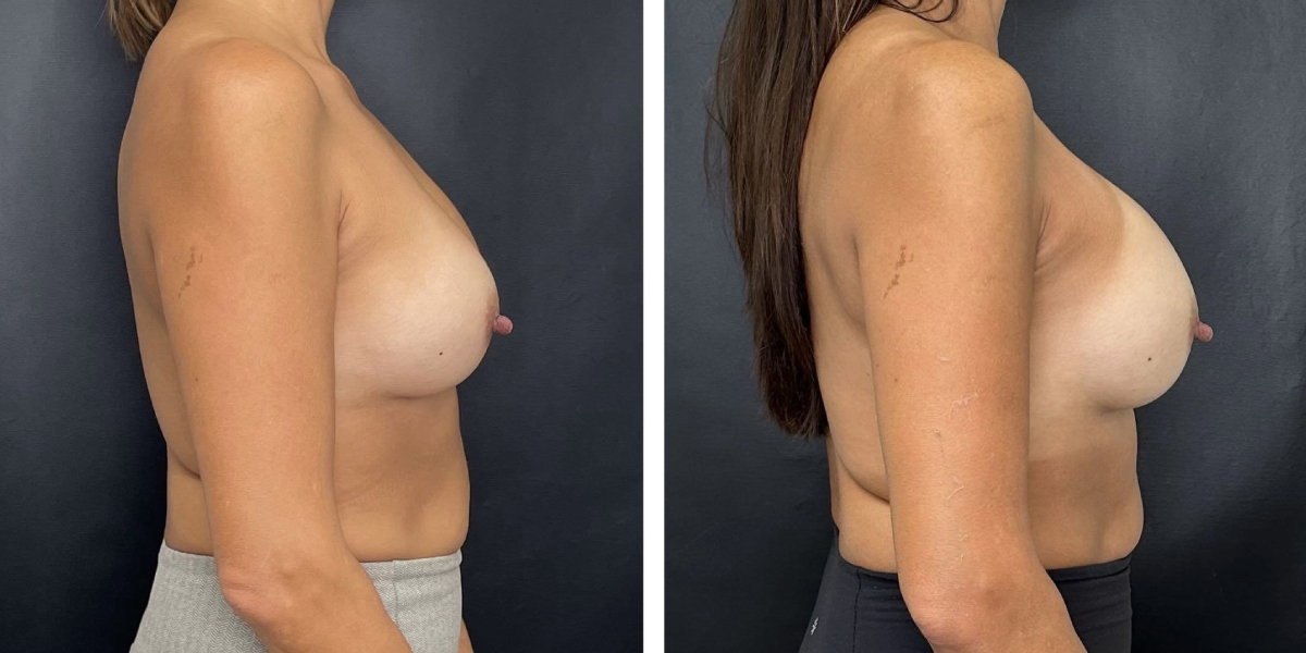 before and after breast implant exchange female patient right side view case 4756